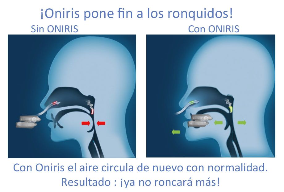ONiRiS AntiRonquidos - Ortesis Avance Mandibular