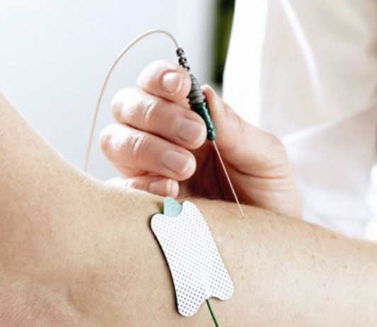 Aguja Concentrica / AMBU Neuroline / 50x0.45mm / 26G / Amarillo / Caja 25 uds. 