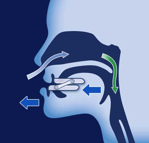 ONiRiS AntiRonquidos - Ortesis Avance Mandibular