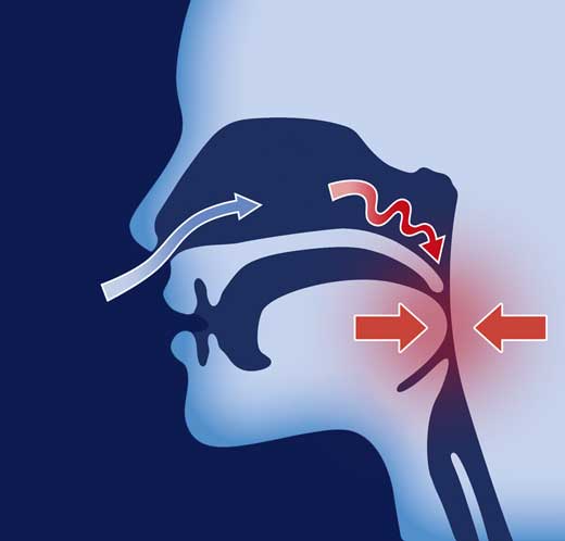 ONiRiS AntiRonquidos - Ortesis Avance Mandibular